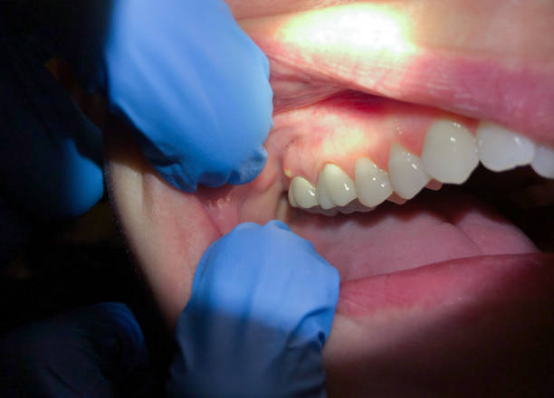 Best Emergency Gum Treatment in Woody, WA