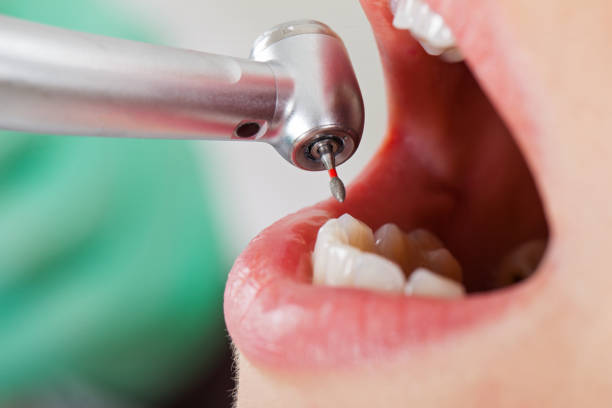 Best Emergency Tooth Extraction in Woody, WA